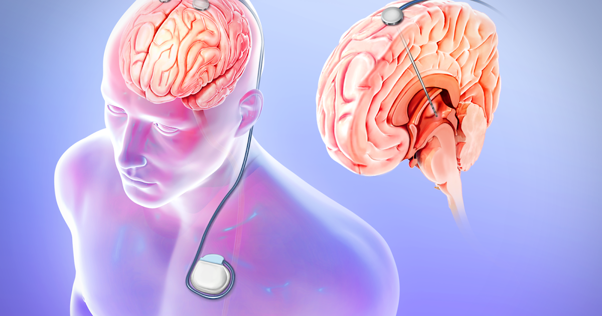 Deep brain stimulation diagram